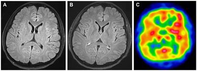 Efficacy of steroid therapy in the acute stage of anti-NMDAR and anti-MOG antibody overlapping encephalitis: a case report and literature review